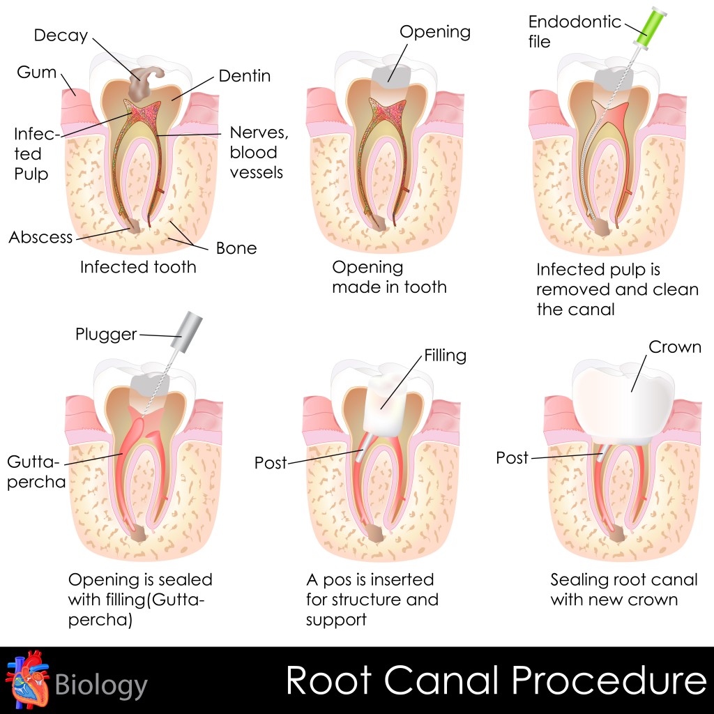 Root Canal Procedure